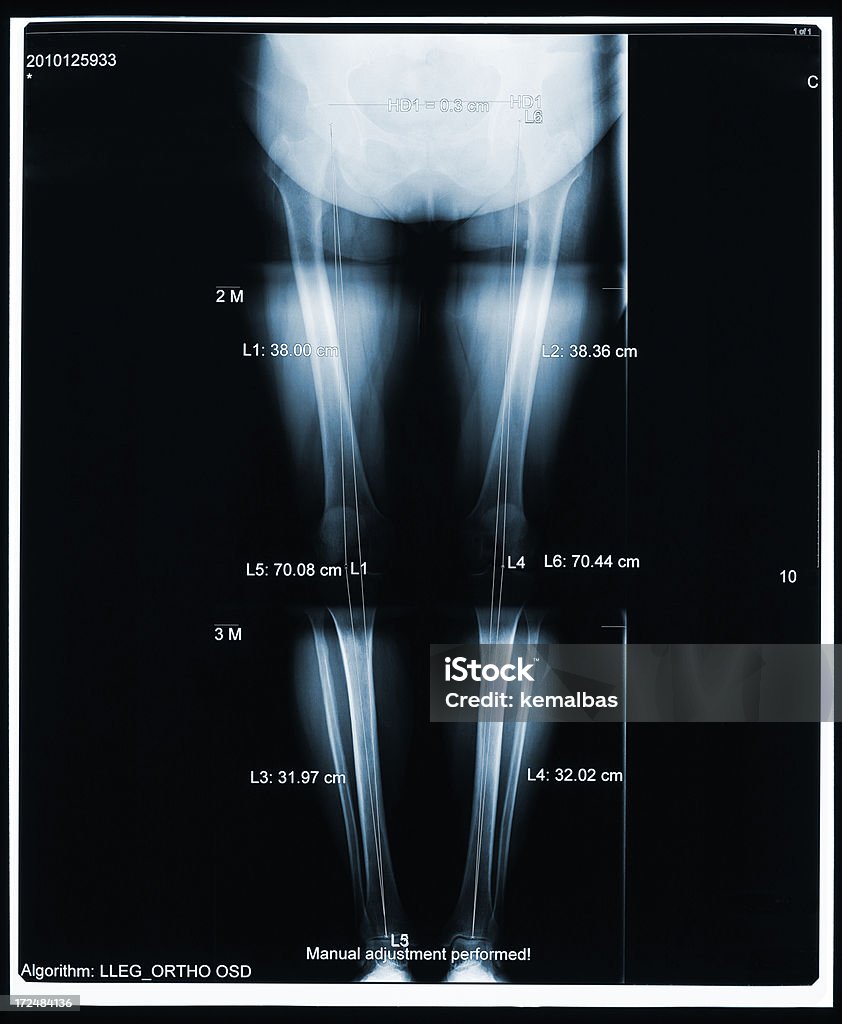 X-ray de perna - Foto de stock de Anatomia royalty-free