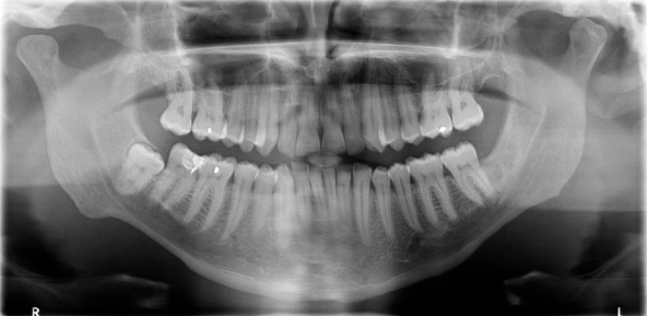 panoramic dental x-ray of my teeth prior to the removal of a final wisdom tooth seen on the right side