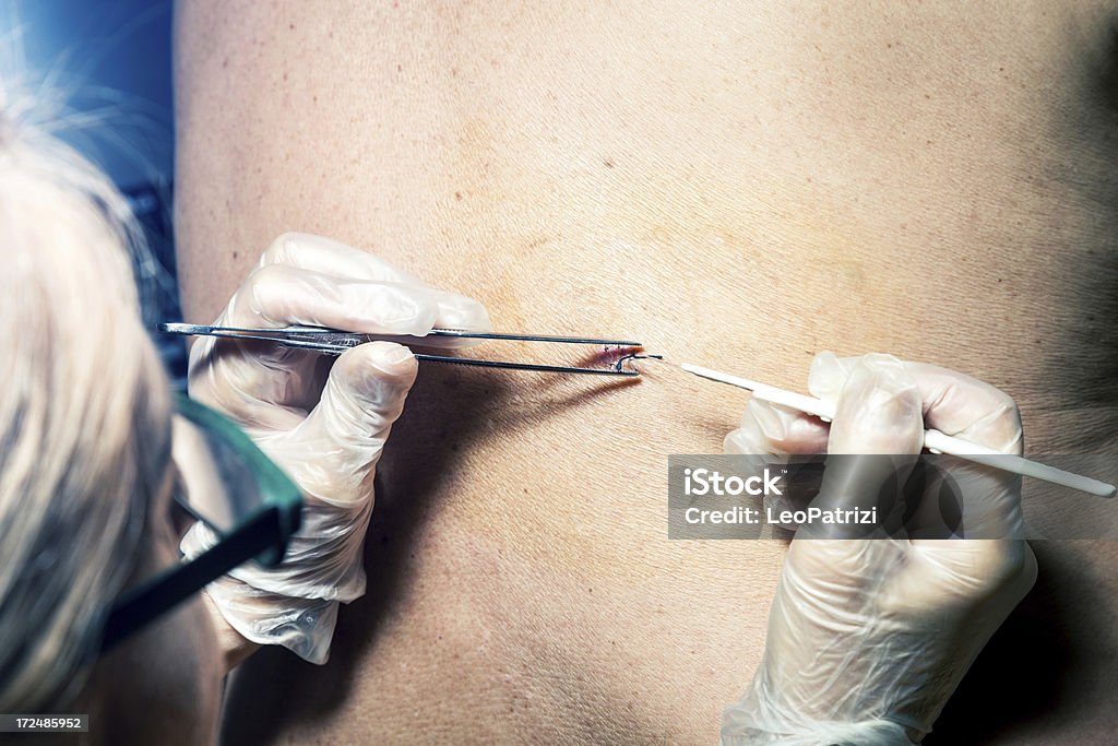 Feminino médico remover stitches - Foto de stock de Acidente royalty-free