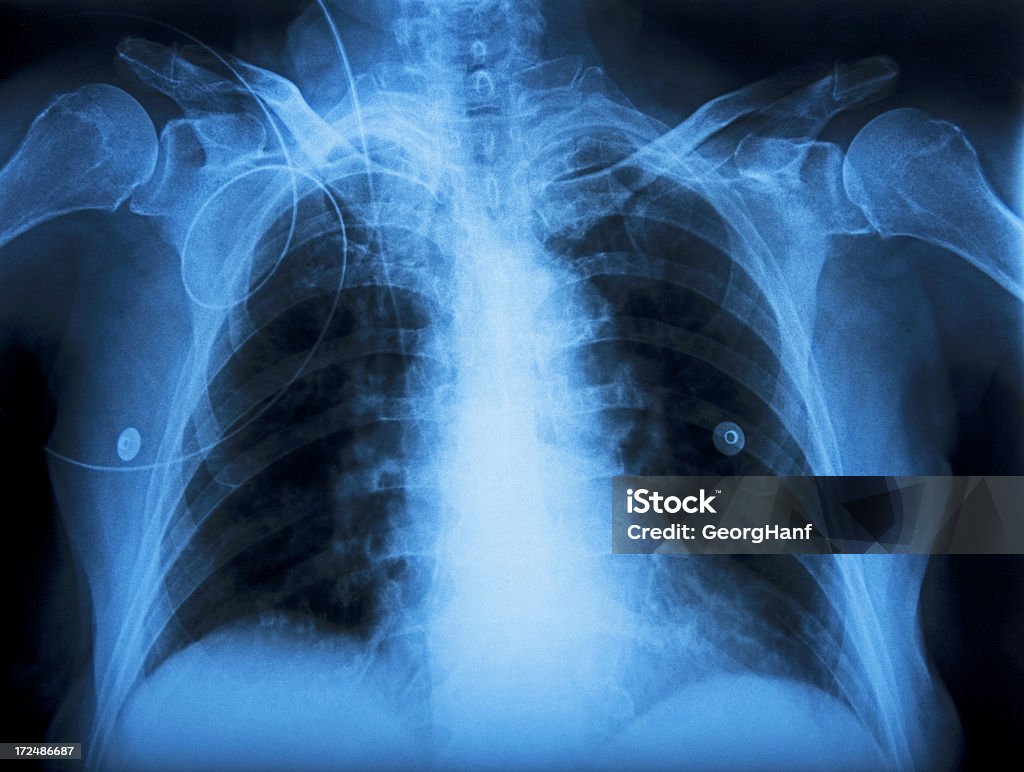 Polmone umano - Foto stock royalty-free di Anatomia umana