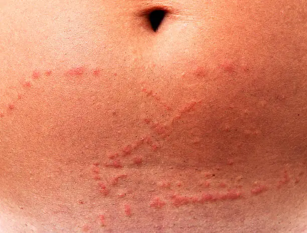 Photo of Jellyfish Sting (XXXL)