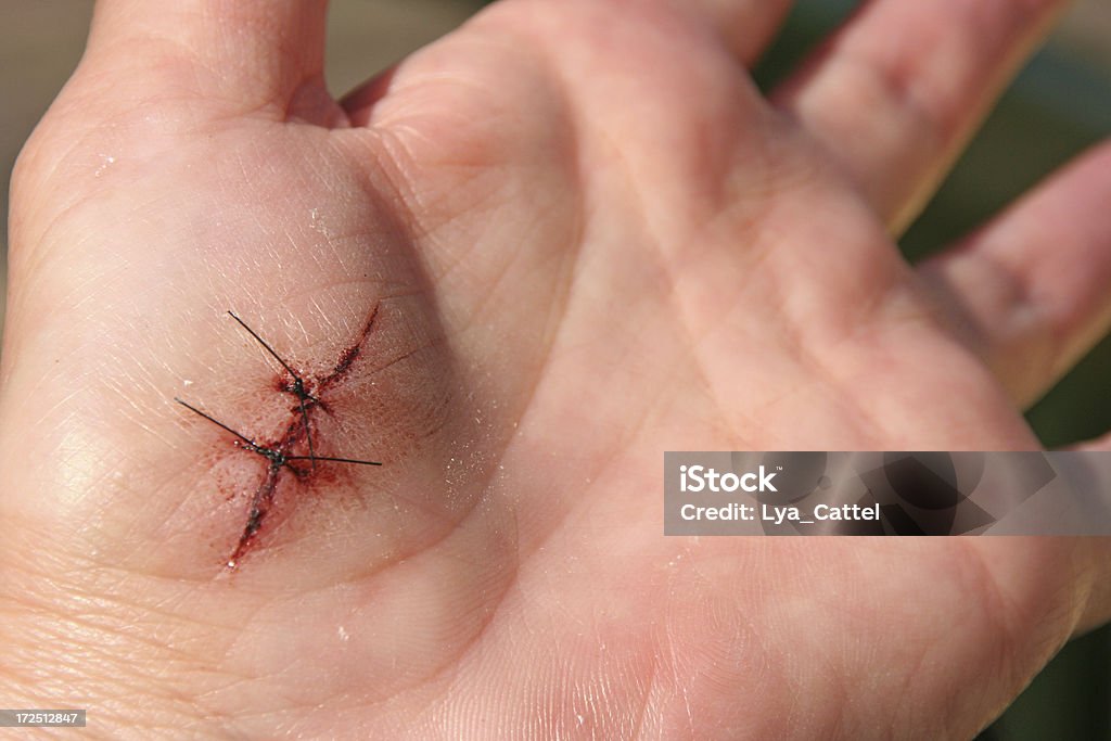 Mano con punti di sutura - Foto stock royalty-free di Ferito
