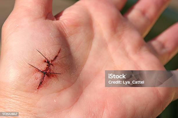 Mano Con Punti Di Sutura - Fotografie stock e altre immagini di Ferito - Ferito, Cucitura visibile, Punti di sutura