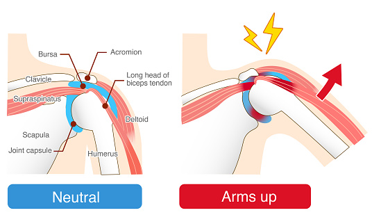 Impingement Syndrome. Causes and Mechanisms of Pain When Raising the Arm