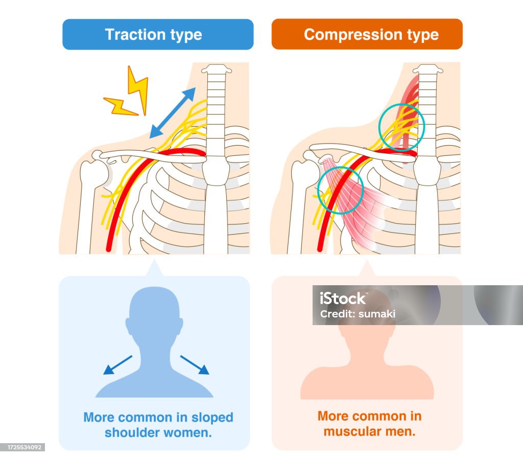 Compression Syndrom Two Types Of Thoracic Outlet Syndrome Traction And Compression Stock ...