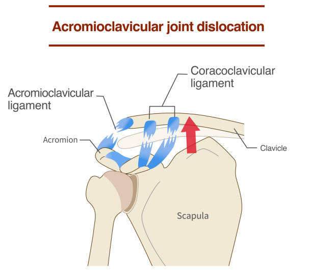 Dislocation of the acromioclavicular joint and ligaments ripl fitness