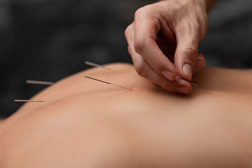 A masseuse performs acupuncture on a girl on a massage table
