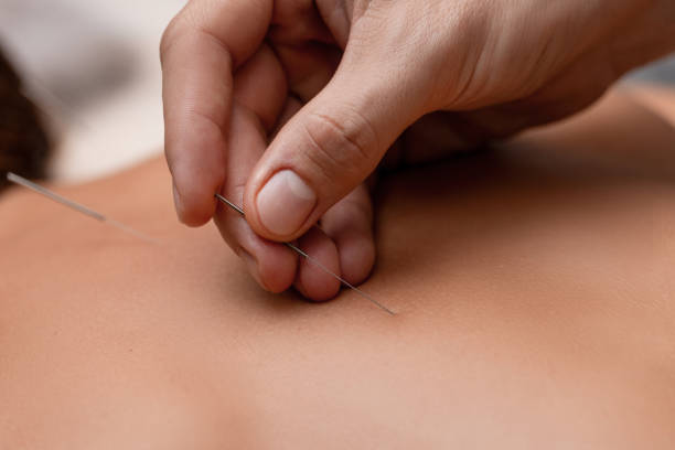 istock A masseuse performs acupuncture on a girl on a massage table 1725603676