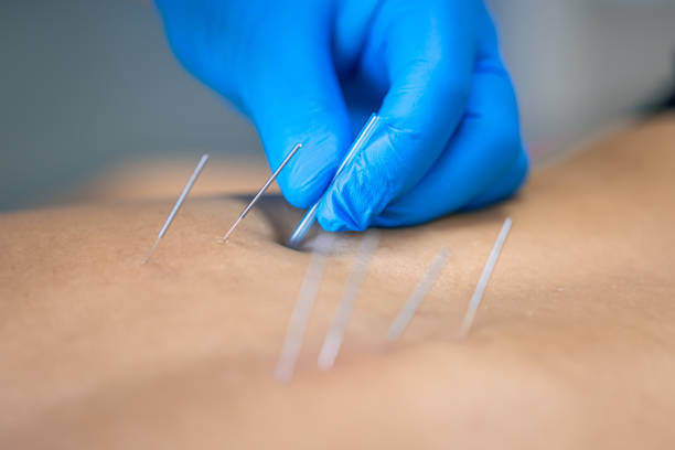 Close up of a needle and hands of physiotherapist doing a dry needling. stock photo