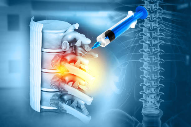 istock 3d illustration of a lumbar spine injection 1725805868