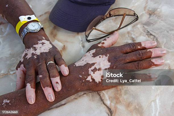 Foto de Vitiligo Nas Mãos E Braços e mais fotos de stock de Adulto - Adulto, Beleza, Braço humano