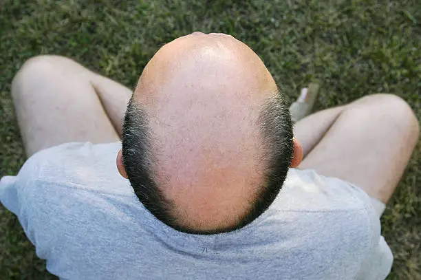 Balding head.