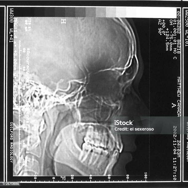 Ct Tomografía Foto de stock y más banco de imágenes de Artículo médico - Artículo médico, Cráneo humano, Cuadrado - Composición