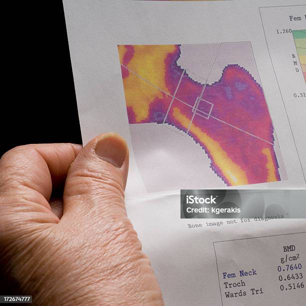 Osteoporoza Test - zdjęcia stockowe i więcej obrazów Osteoporoza - Osteoporoza, Anatomia człowieka, Badania kliniczne