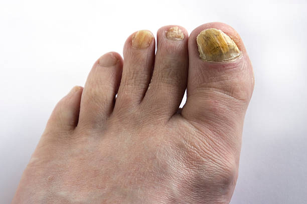 足の爪菌 - fungus toenail human foot onychomycosis ストックフォトと画像