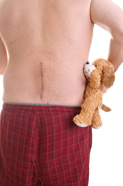 Back Surgery Series Man holds his teddy bear to comfort himself after recent back surgery with big long surgical scar with staples running in a vertical line on lower torso scar surgery rear view human spine stock pictures, royalty-free photos & images