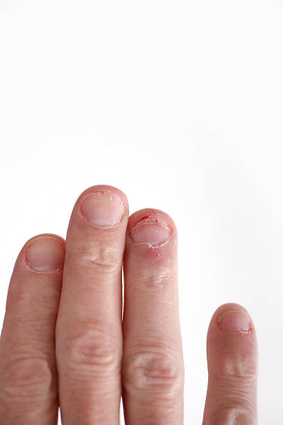 morder fingernails - nail biting biting fingernail obsessive fotografías e imágenes de stock