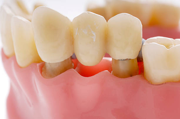 istock model of dental bridge used to replace missing tooth 172773973