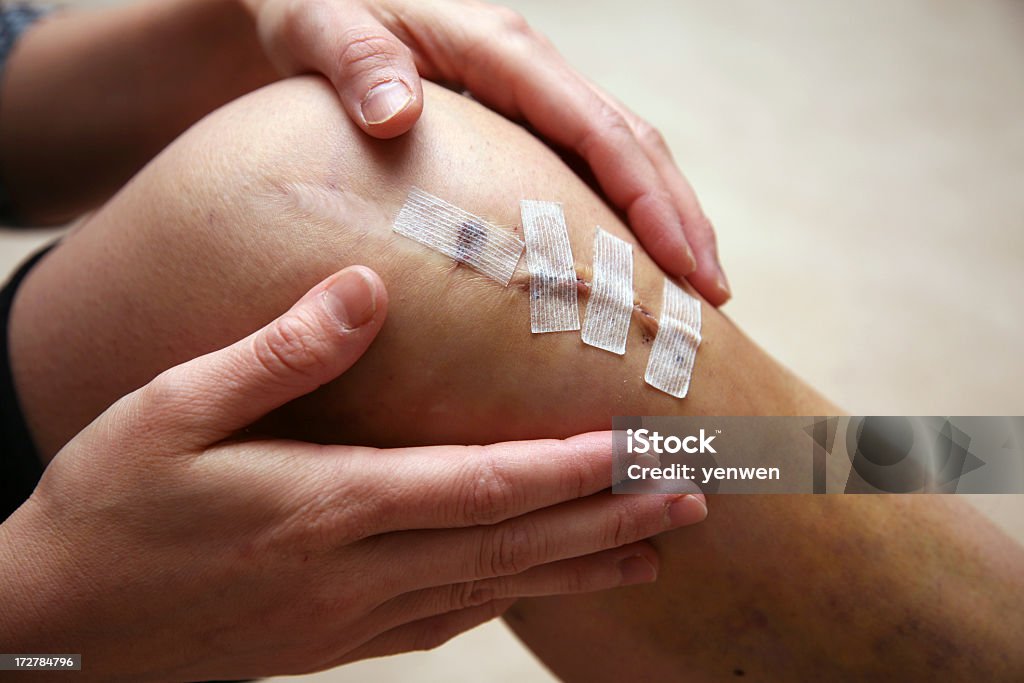 Травмы колена - Стоковые фото Операция роялти-фри