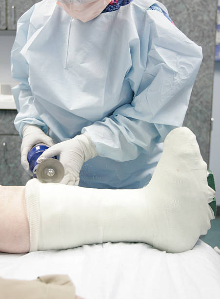 Cast being removed stock photo