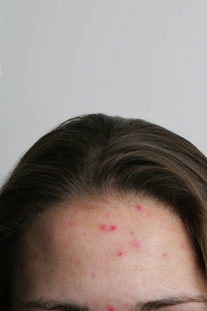 Acne sulla fronte - foto stock