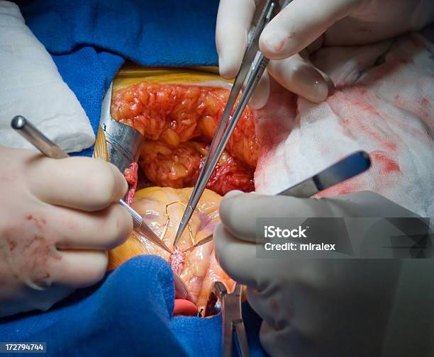 Cirujano Realiza Lima Anastomosis Para Pacientes Que Requieren Cabg Foto de stock y más banco de imágenes de Arteria coronaria