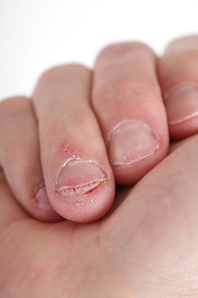 morder fingernails - nail biting biting fingernail obsessive fotografías e imágenes de stock