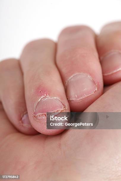 Кусать Fingernails — стоковые фотографии и другие картинки Бабочки в животе - Бабочки в животе, Вертикальный, Вредная привычка