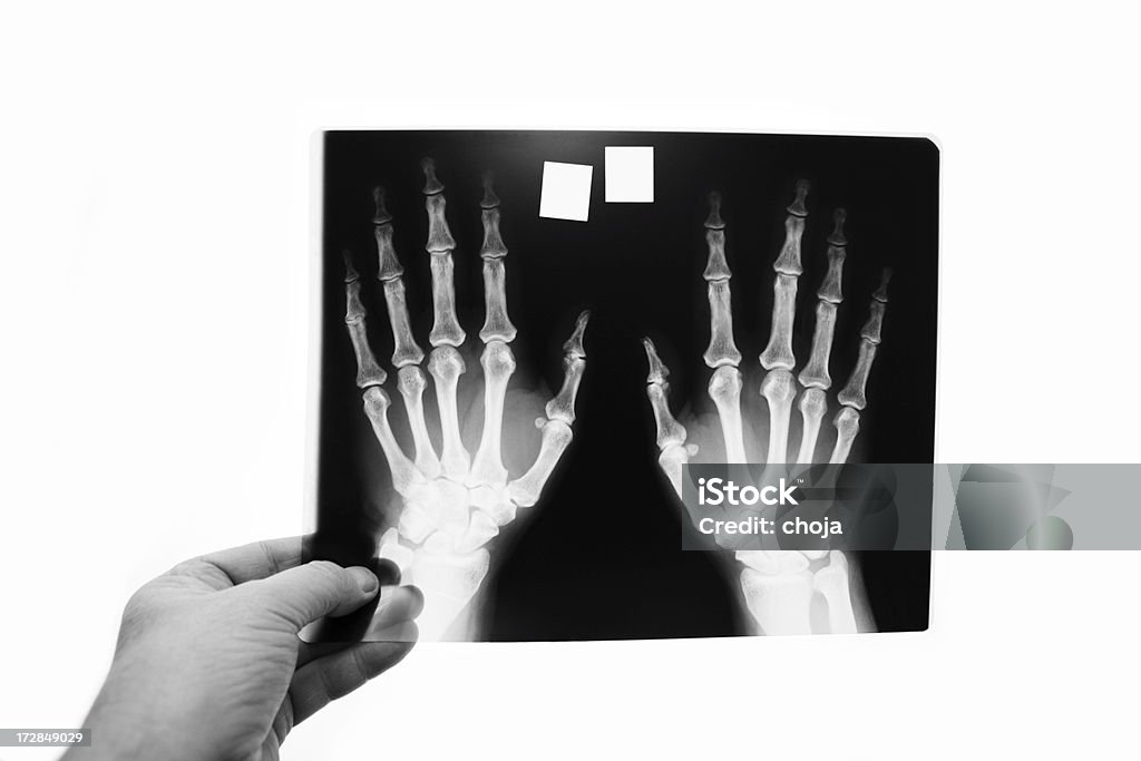 Рентгеновское изображение человека руки, размер XXL - Стоковые фото Артрит роялти-фри