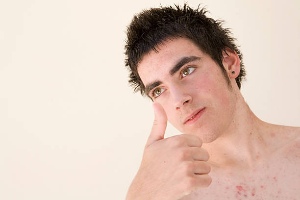 istock teen with spots 172863329