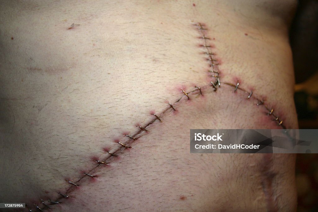 Moderna e antica cicatrice-intervento chirurgico - Foto stock royalty-free di Addome