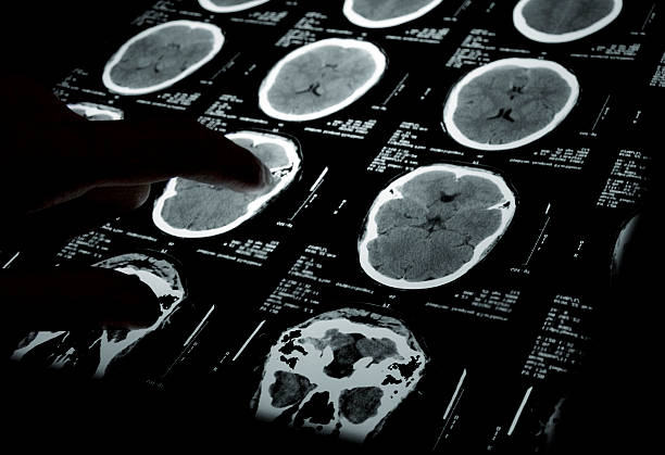 CT 뇌 스캔 스톡 사진