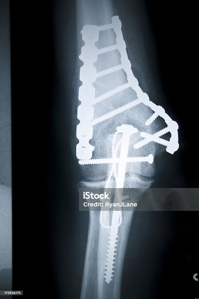 Хирургически ремонта локоть кость клетки Series - Стоковые фото Болт роялти-фри