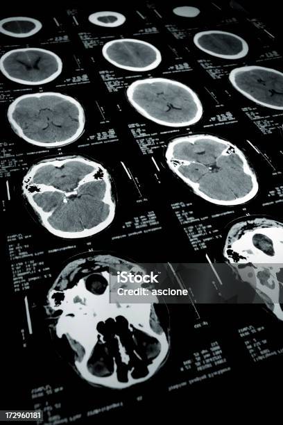 Ct Tomografía Cerebral Foto de stock y más banco de imágenes de Asistencia sanitaria y medicina - Asistencia sanitaria y medicina, Cerebro, Cáncer - Tumor