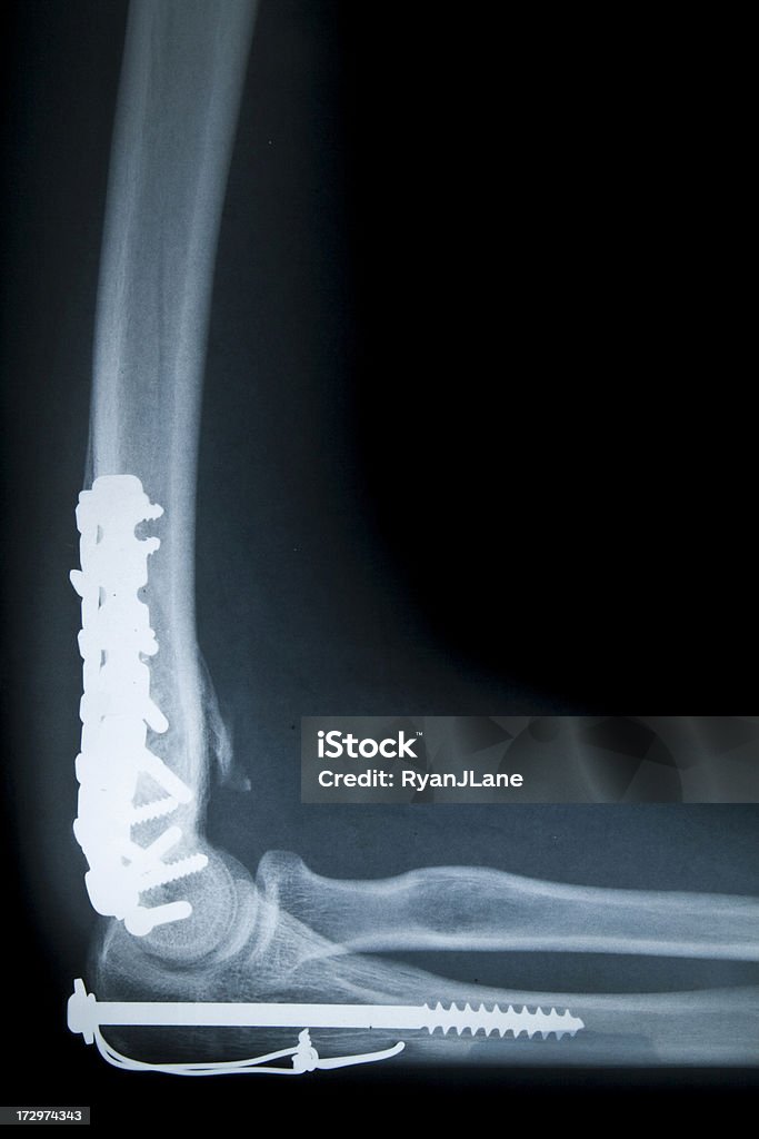 Estar quirúrgicamente reparado en codo radiografía ósea serie - Foto de stock de Articulación libre de derechos