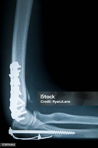 Estar Quirúrgicamente Reparado En Codo Radiografía Ósea Serie Foto de stock y más banco de imágenes de Articulación