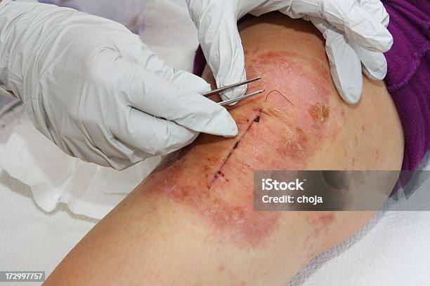 Foto de Enfermeiro Mudança De Faixa Para Um Paciente Após Joelho Operação e mais fotos de stock de Alergia
