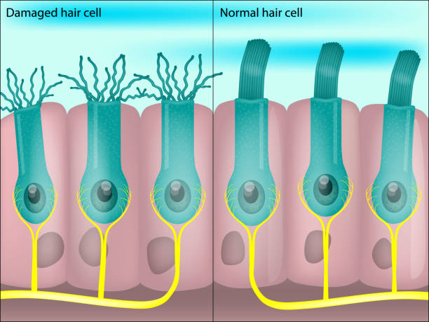 illustrazioni stock, clip art, cartoni animati e icone di tendenza di cellule ciliate sane e danneggiate all'interno della coclea. acufene. perdita dell'udito indotta dal rumore. - perdita delludito