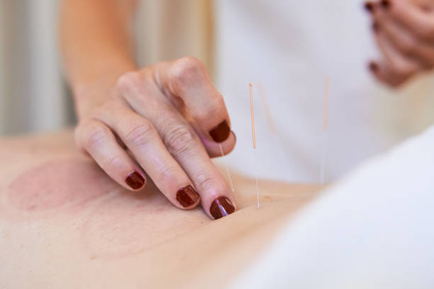 istock Close up of freelancer practitioner performing needle acupuncture therapy on lumbar back area to enhance fertility 1731092128