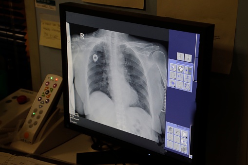 A modern radiology room with a black computer monitor with a diagnostic X-ray image of a human chest