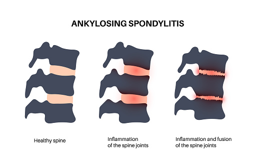 Ankylosing spondylitis. Arthritis that causes inflammation in the joints and ligaments of the spine. Inflamed and fusion vertebrae in the spinal column. Hip and lower back pain vector illustration