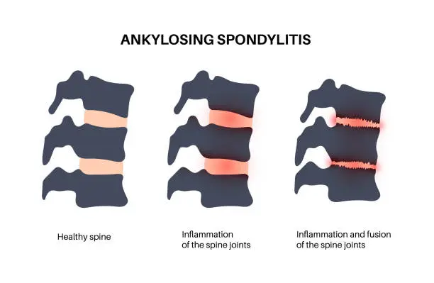 Vector illustration of Ankylosing spondylitis disease