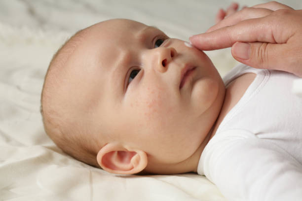 istock The hand of a mother applying ointment to a baby's check 173250847