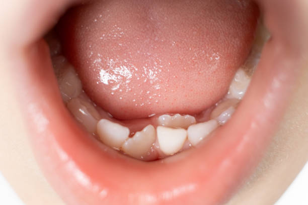 istock Crookedly growing teeth to replace milk teeth in a child. The second row of teeth, the tooth grows while the incisor has not yet fallen out. 1733882355