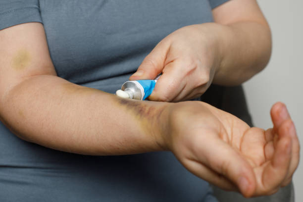 istock Applying a white cream to cure bruise on arm 1734948245