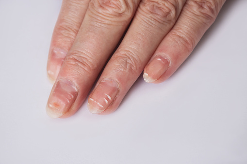 a close-up photo of the fingers of a female age-old hand with white stripes on the nails. Isolated on a white background. Lack of vitamins and minerals in the body.