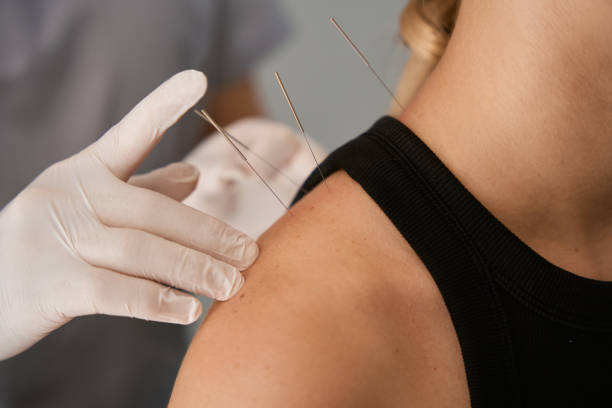 Reflexologist conducts an acupuncture session on a young woman Reflexologist conducts an acupuncture session on a young woman, the specialist works in protective gloves acupuncture stock pictures, royalty-free photos & images