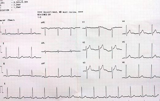 Medical backgrounds, cardiogram close up