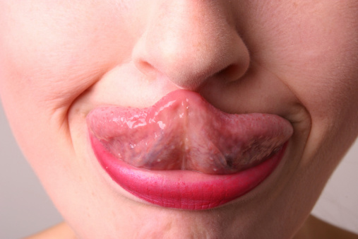 A white male with brown and white facial hair. Tongue is sticking out to show geographic tongue, also known as benign migratory glossitis where lines form and can cause pain or discomfort.