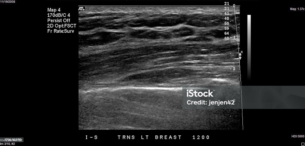 En la ecografía de mamas - Foto de stock de Ecografía libre de derechos